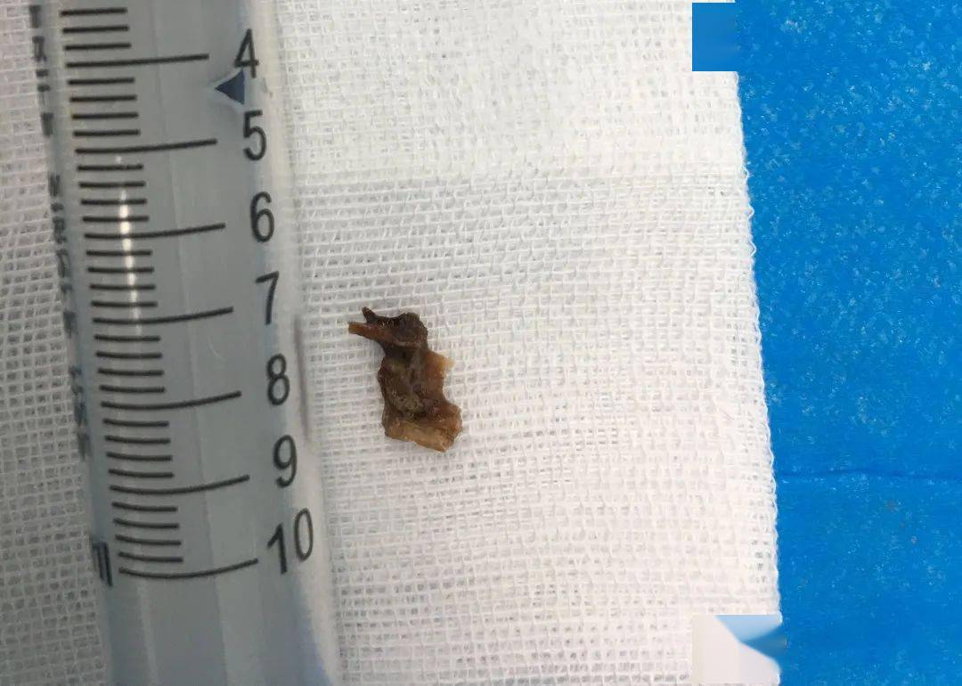 男孩气管卡异物咳嗽一月余医生支气管镜下科学吃鸡