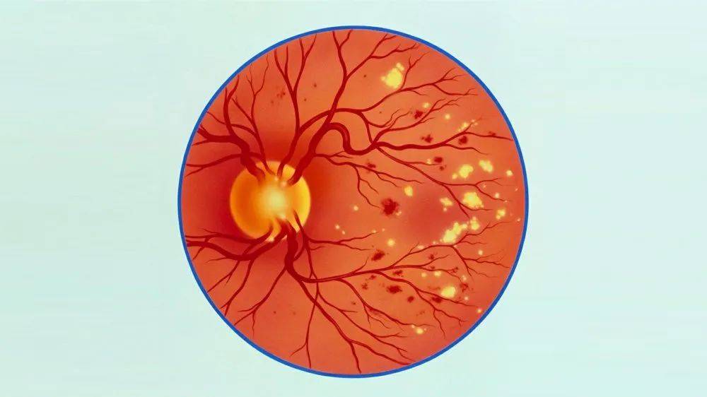 关于糖尿病视网膜病变，您需要知道的_手机搜狐网