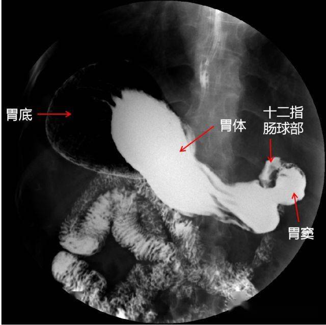 上消化道造影检查技术及常见病变的x线诊断