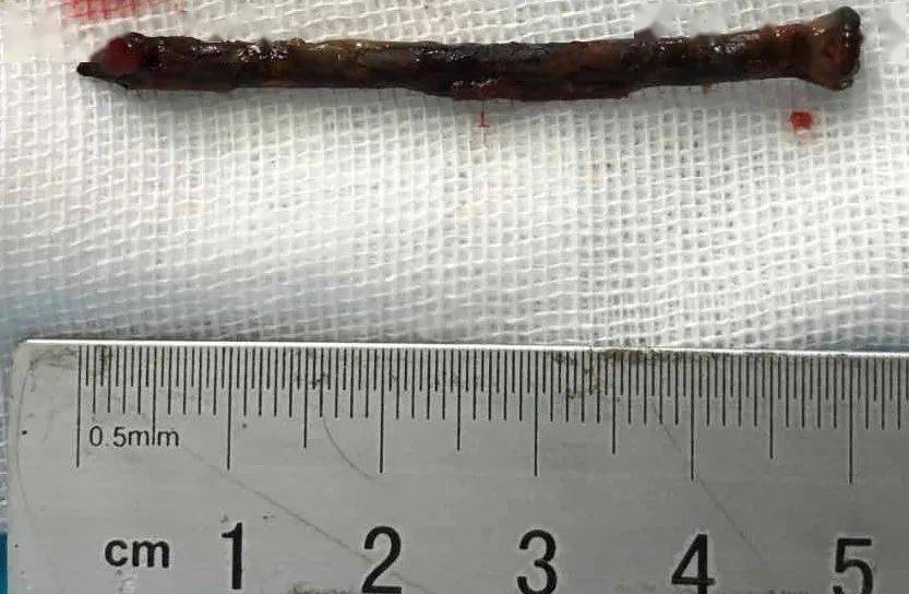 他把一枚铁钉吸到了肺里,还好有安阳地区医院._钉子
