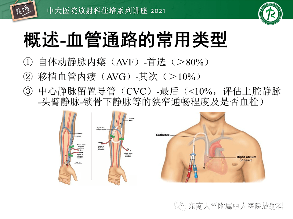 中大放射住培系列講座上肢動靜脈解剖及人工動靜脈造瘻術後cta影像