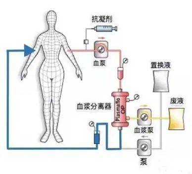 知多d血浆置换治疗肝功能衰竭