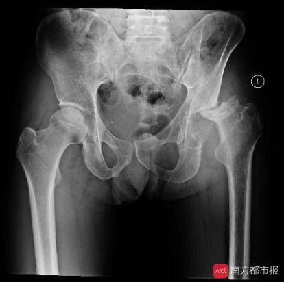 日饮白酒超半斤 五旬大汉股骨头崩塌