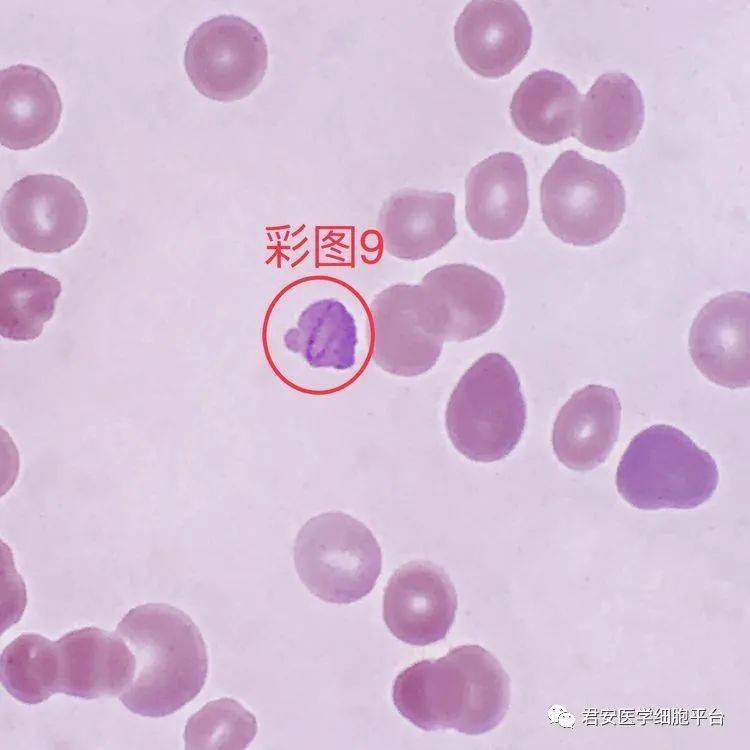 ▼「卡波环(cabot ring)」形态特征:在嗜多色性或嗜碱性点彩红细胞胞