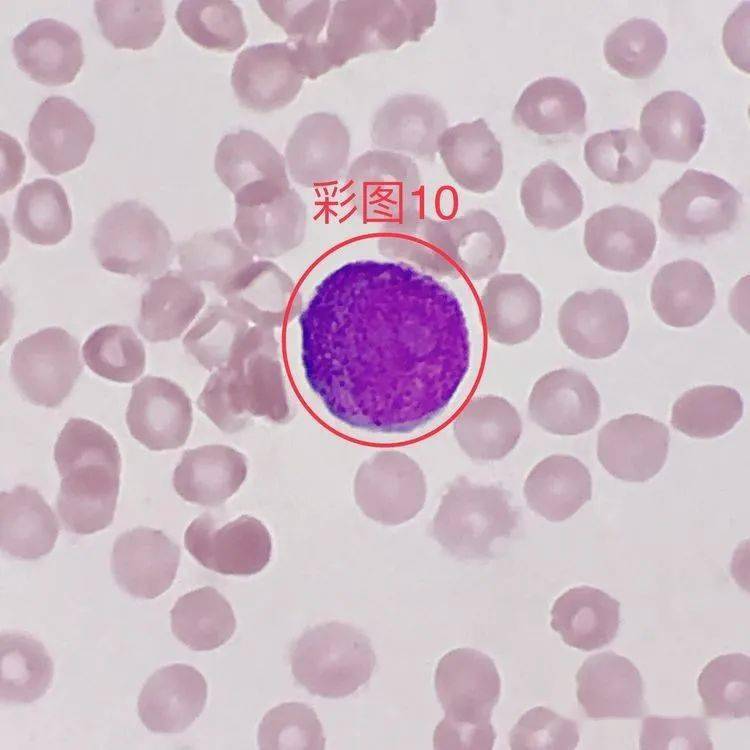 形态特征:在嗜多色性或嗜碱性点彩红细胞胞质中出现的紫红色细线圈状
