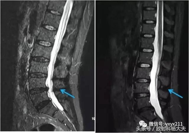 为大家方便理解,以下两幅图作为对比,没有棘上棘间韧带炎的,相同区域