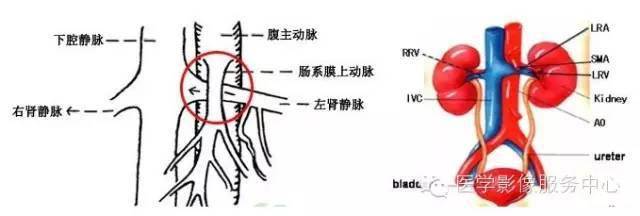 女性左肾静脉胡桃夹图片