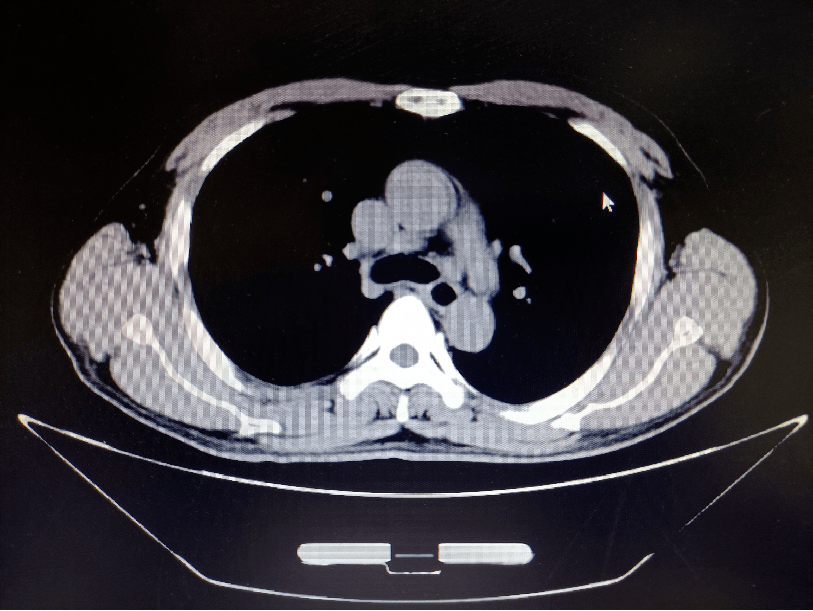 复查ct:食管化疗后,胸中下段管壁略见增厚,最厚处约为0.7cm(201.