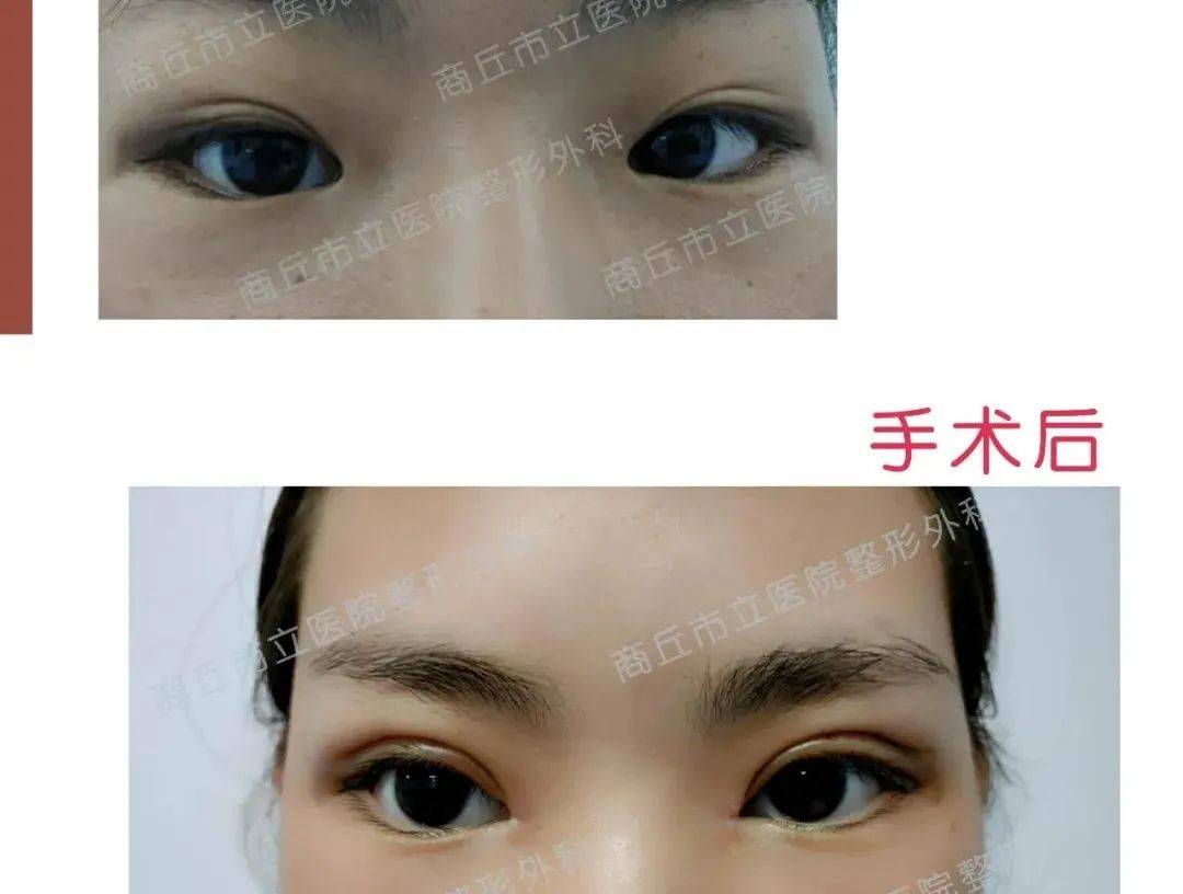 眼部整形医院排名_眼部整形前后对比图(2)