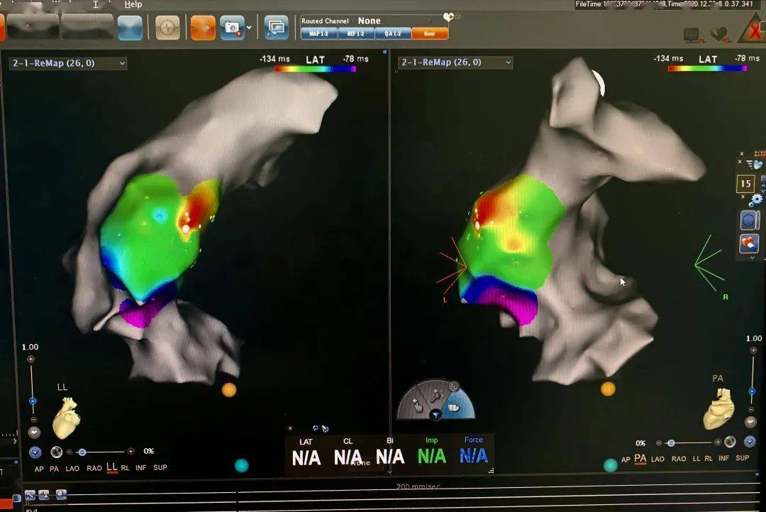 动态心电图室性早搏多少次算正常 4f42b5ecc3c84d37bea01aa5ce39187a.jpeg
