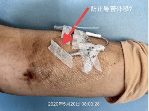 这样固定导管穿刺点,小心摊上大事!