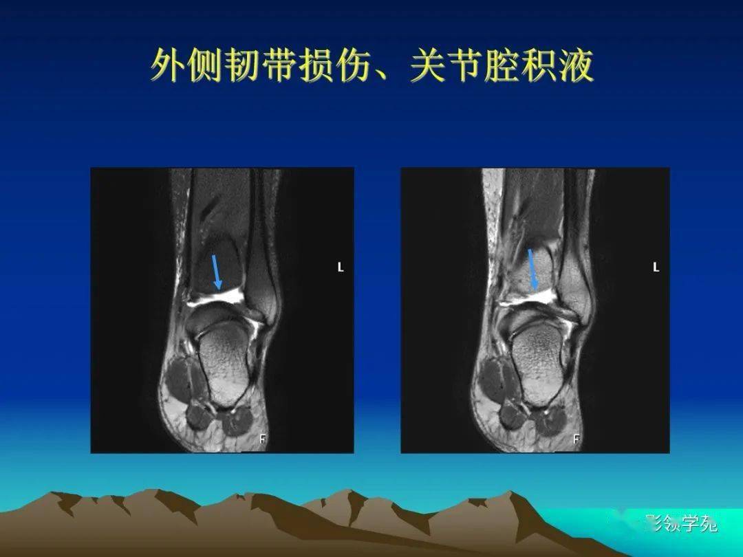 距腓前韧带MRI图片