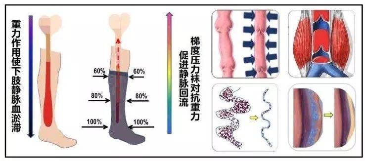 用弹力袜的原理是什么_弹力球是什么材料(2)