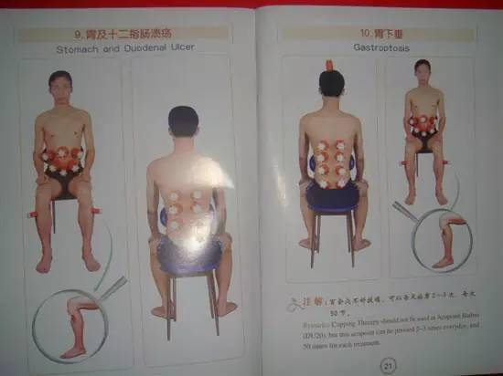 最全拔罐穴位疗法图解拔上一罐病去一半