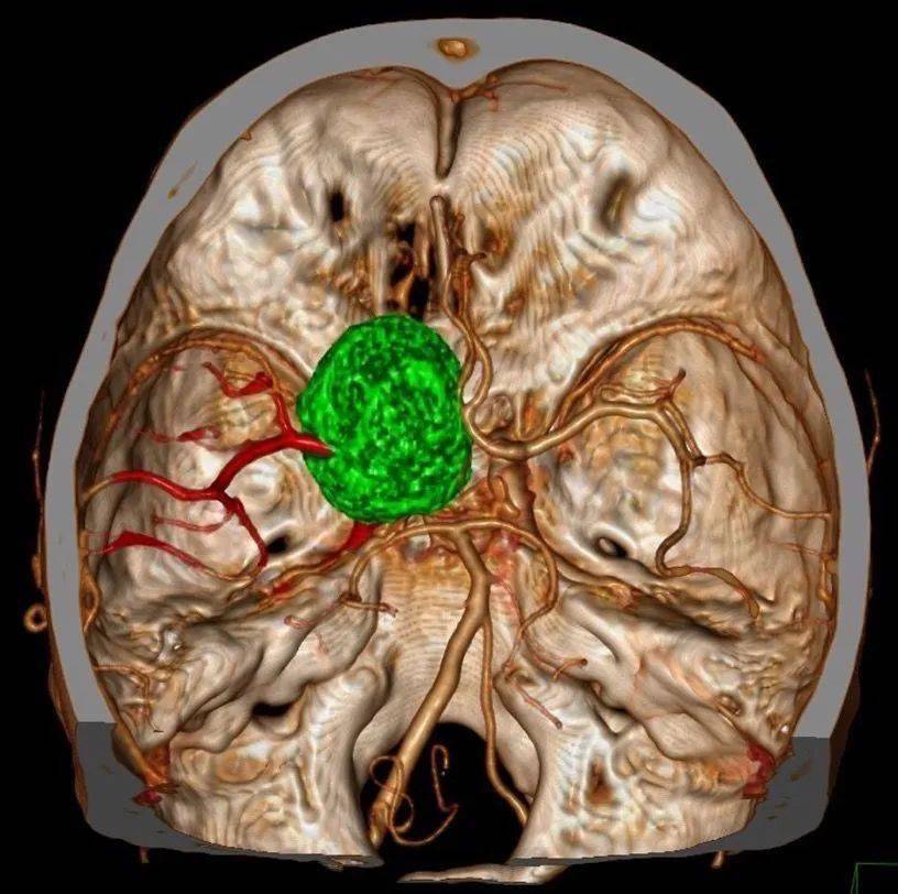 病例分享蒋磊副教授前床突脑膜瘤的手术治疗
