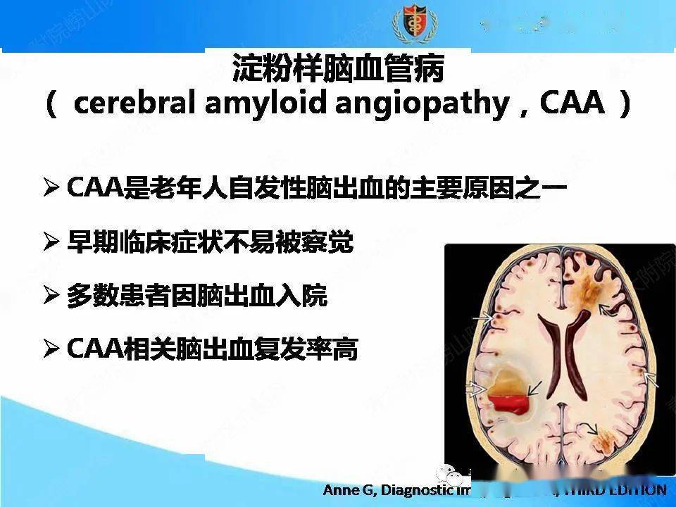 【影像】澱粉樣腦血管病的影像診斷與鑑別診斷