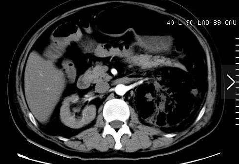 检查发现一侧肾脏「消失」?可能是这些原因