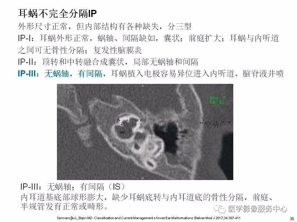 内耳正常解剖及畸形分类