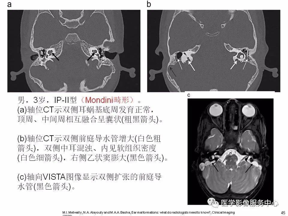内耳正常解剖及畸形分类