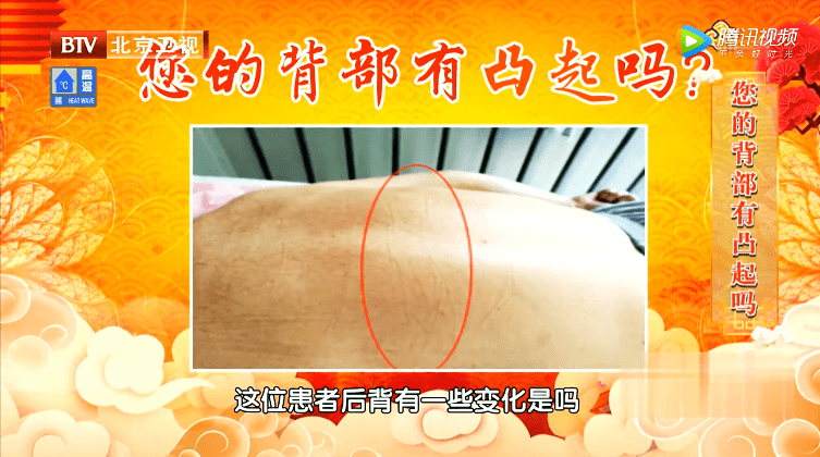 这里凸起,肝火太旺,拔上一罐就见效!