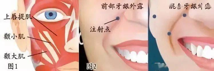 颜值杀手露龈笑影响颜值有办法改善吗