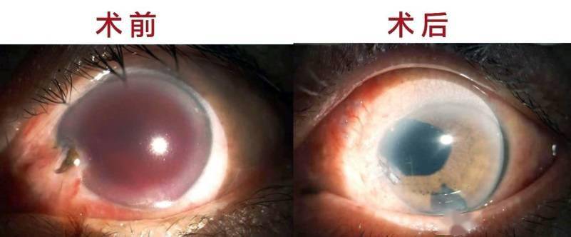 立马为老周行相关检查,发现左眼球内磁性异物,角膜穿通伤伴虹膜,玻璃