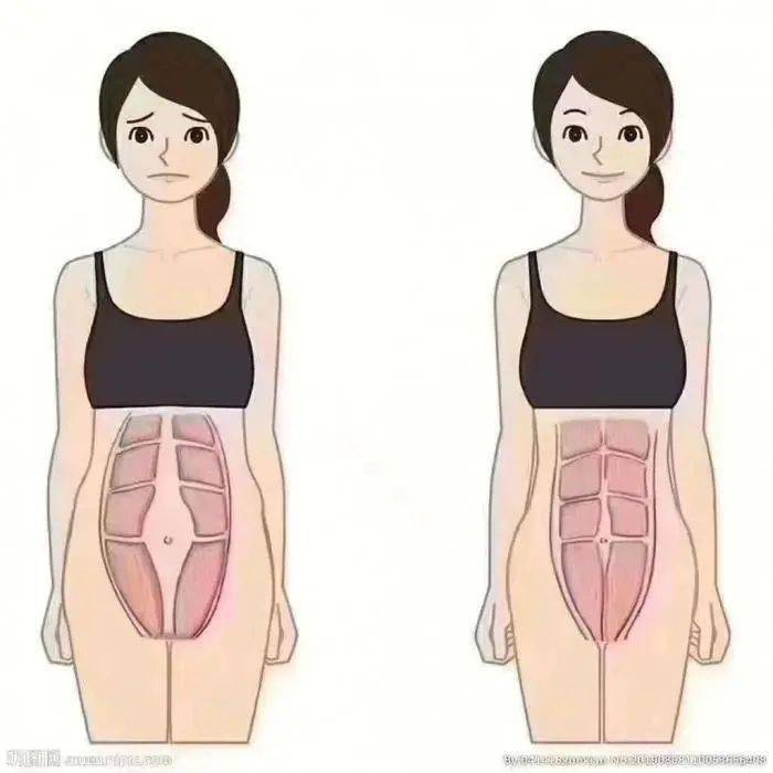 科普 腹直肌分离 妊娠期及产后常见并发症 的康复治疗 肌肉