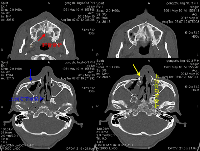 上颌窦前壁骨折右下:上颌骨额突骨折左上:眼眶外侧壁骨折右上:鼻中隔