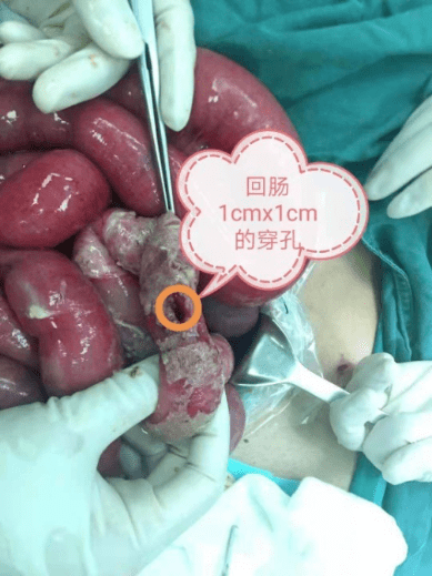 腹部疼痛6小时,到院竟被告知是肠破裂,原来事发时他.