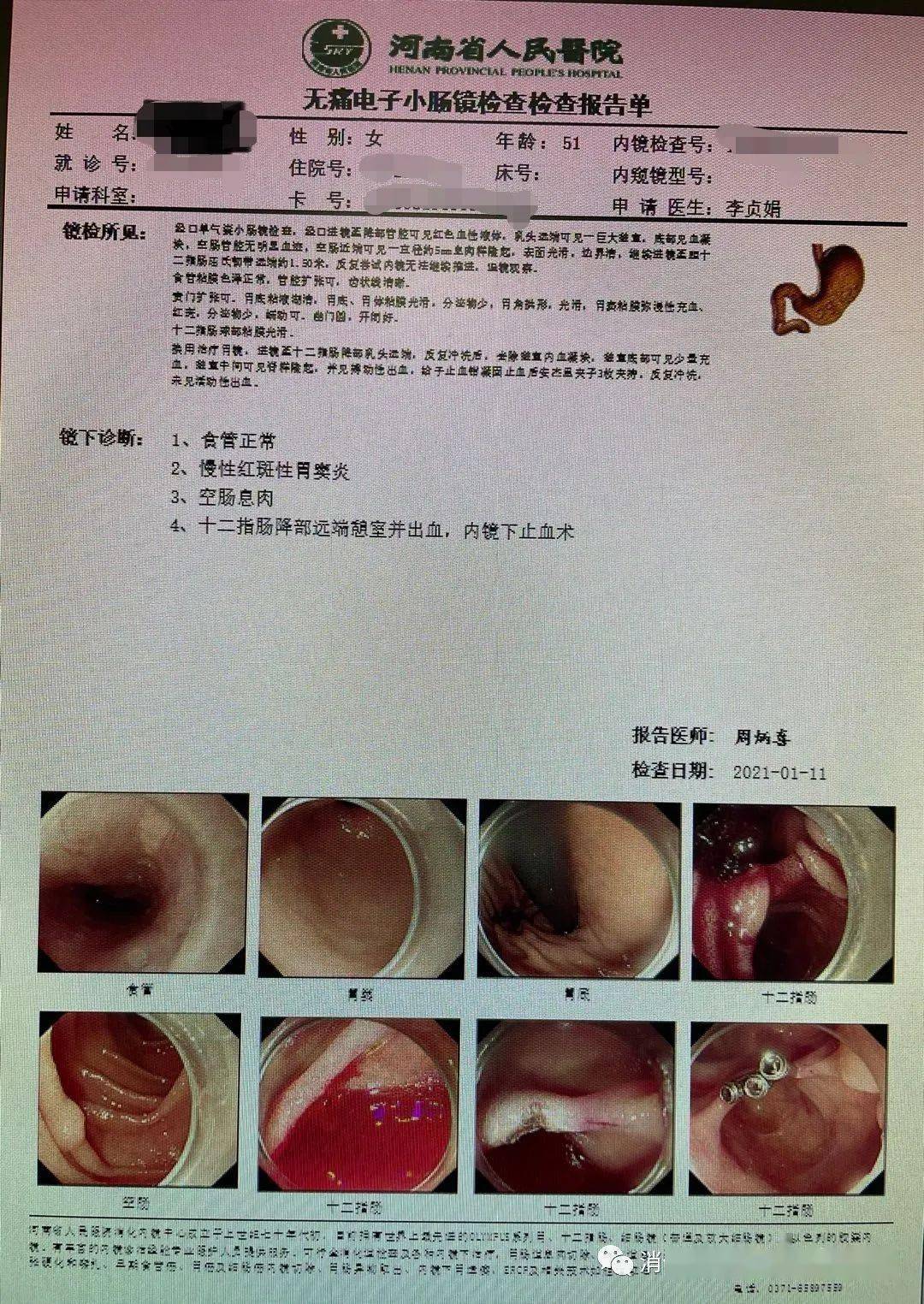 10幾年反覆消化道出血究竟病在哪裡(二)_十二指腸