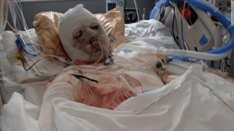 一场车祸后,他移植了全脸和双手_梅奥