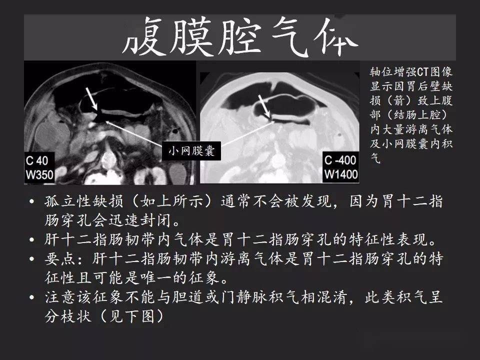 胃腸穿孔氣從哪裡來通過腹膜解剖確定穿孔部位