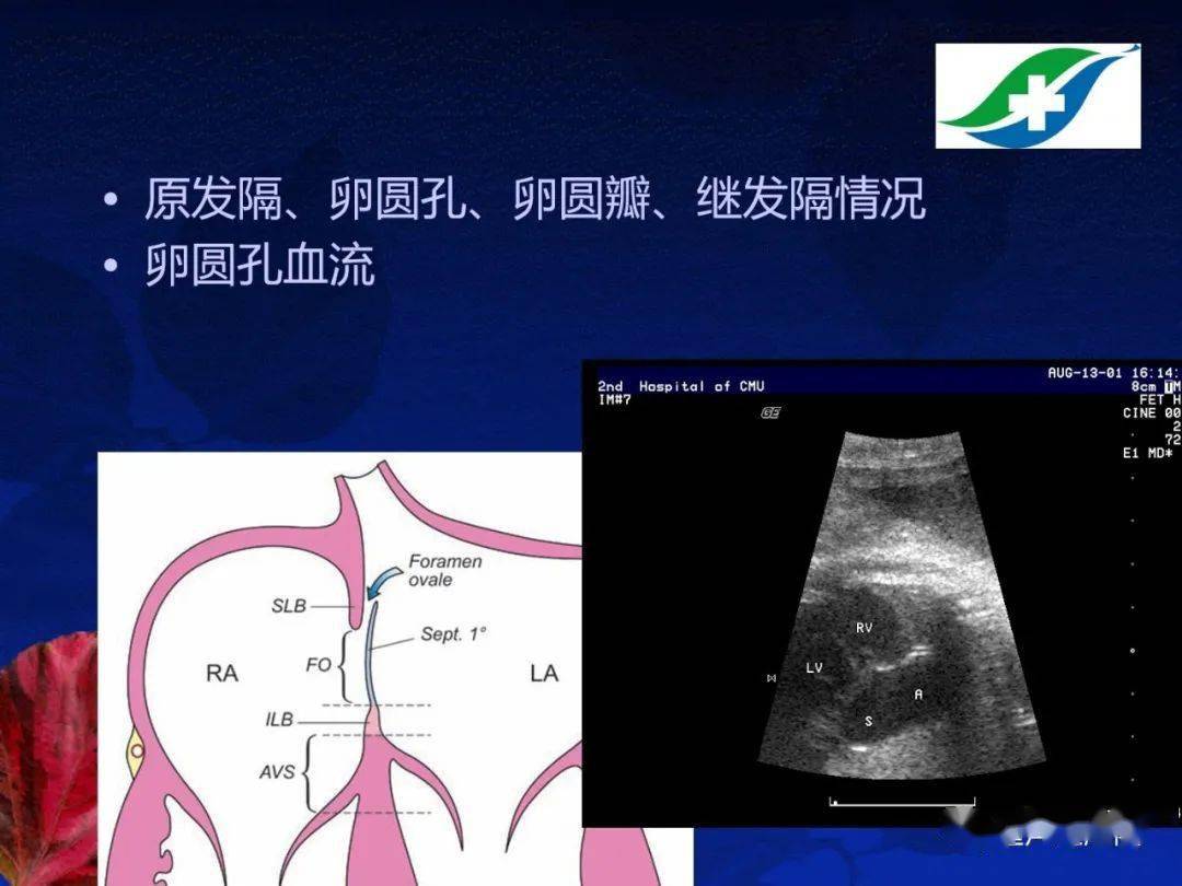 胎儿超声心动图基础及切面