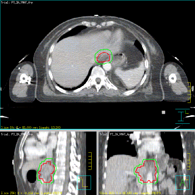 及计划:治疗方案:挽救性同步放化疗(2019年11月)首次复发pet-ctpet-ct