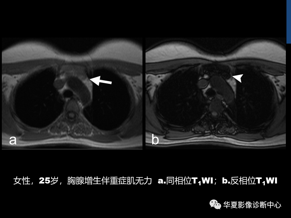 胸腺瘤影像診斷及分期