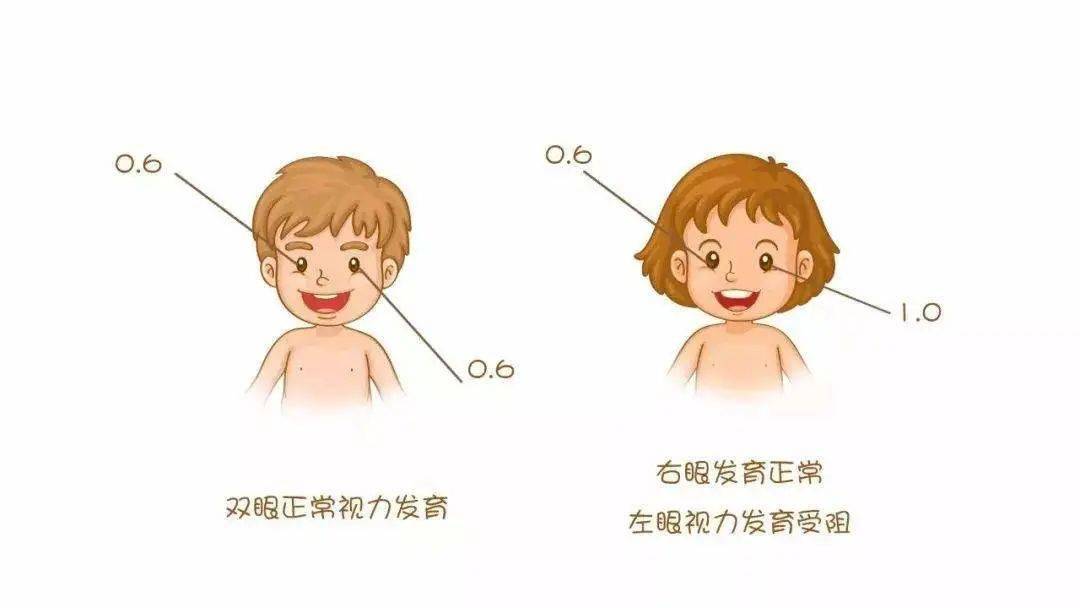 孩子弱视不能拖,千万别错过治疗黄金期!