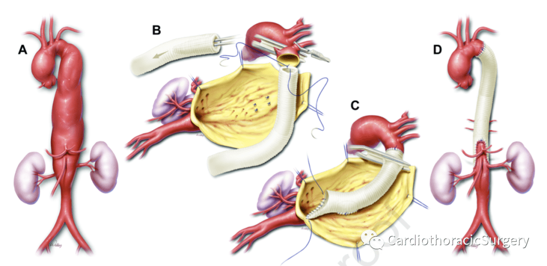 jtcvs丨应用逆向象鼻技术分阶段治疗广泛胸主动脉瘤-23年经验_手术