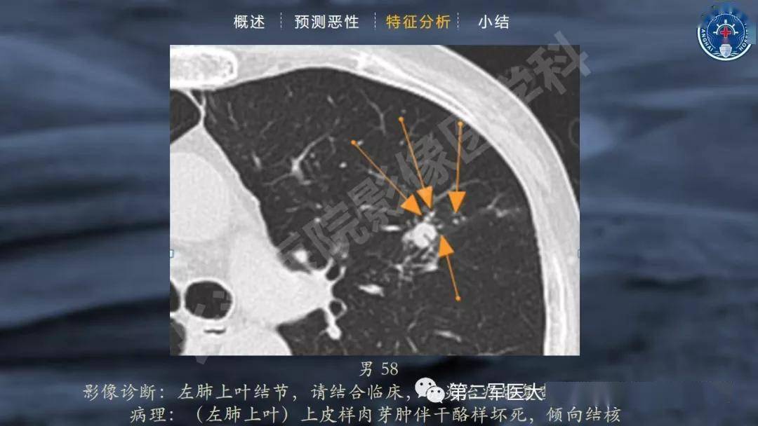 實性肺結節的良惡性ct徵象解析