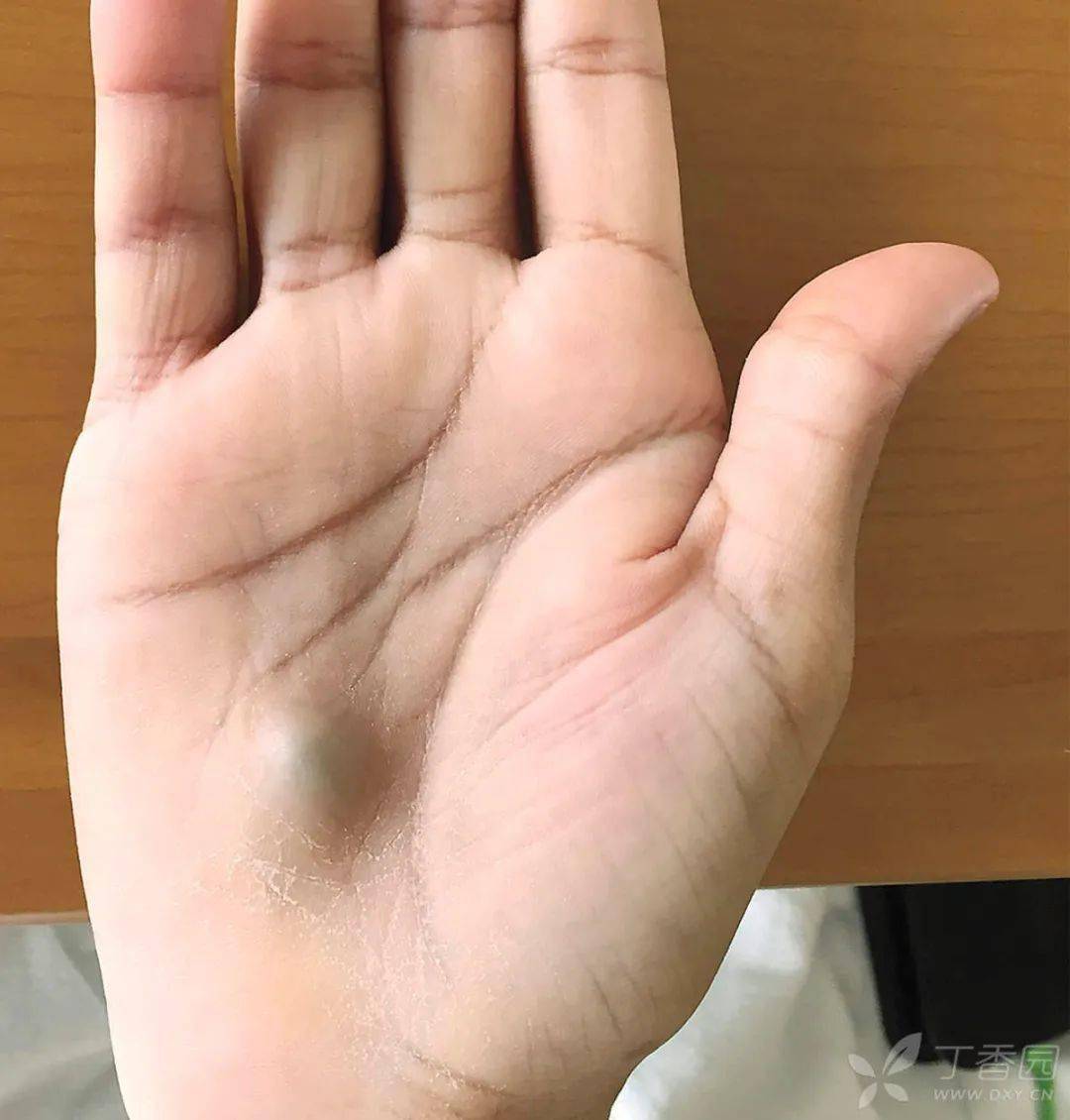 右手肿起一个「大疙瘩」并搏动性,会是啥?
