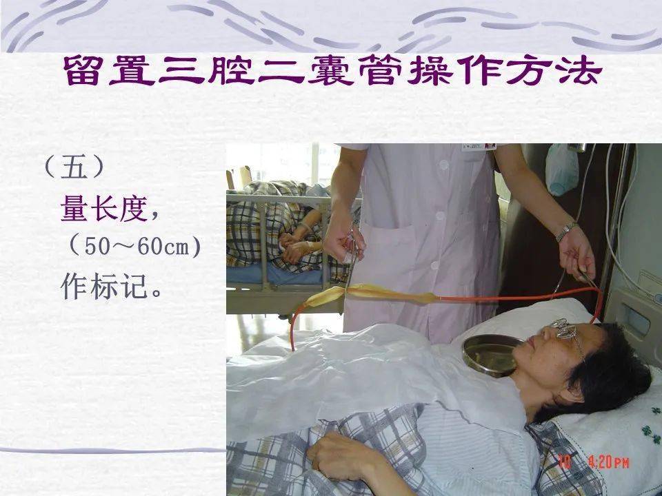 三腔二囊管的应用及护理
