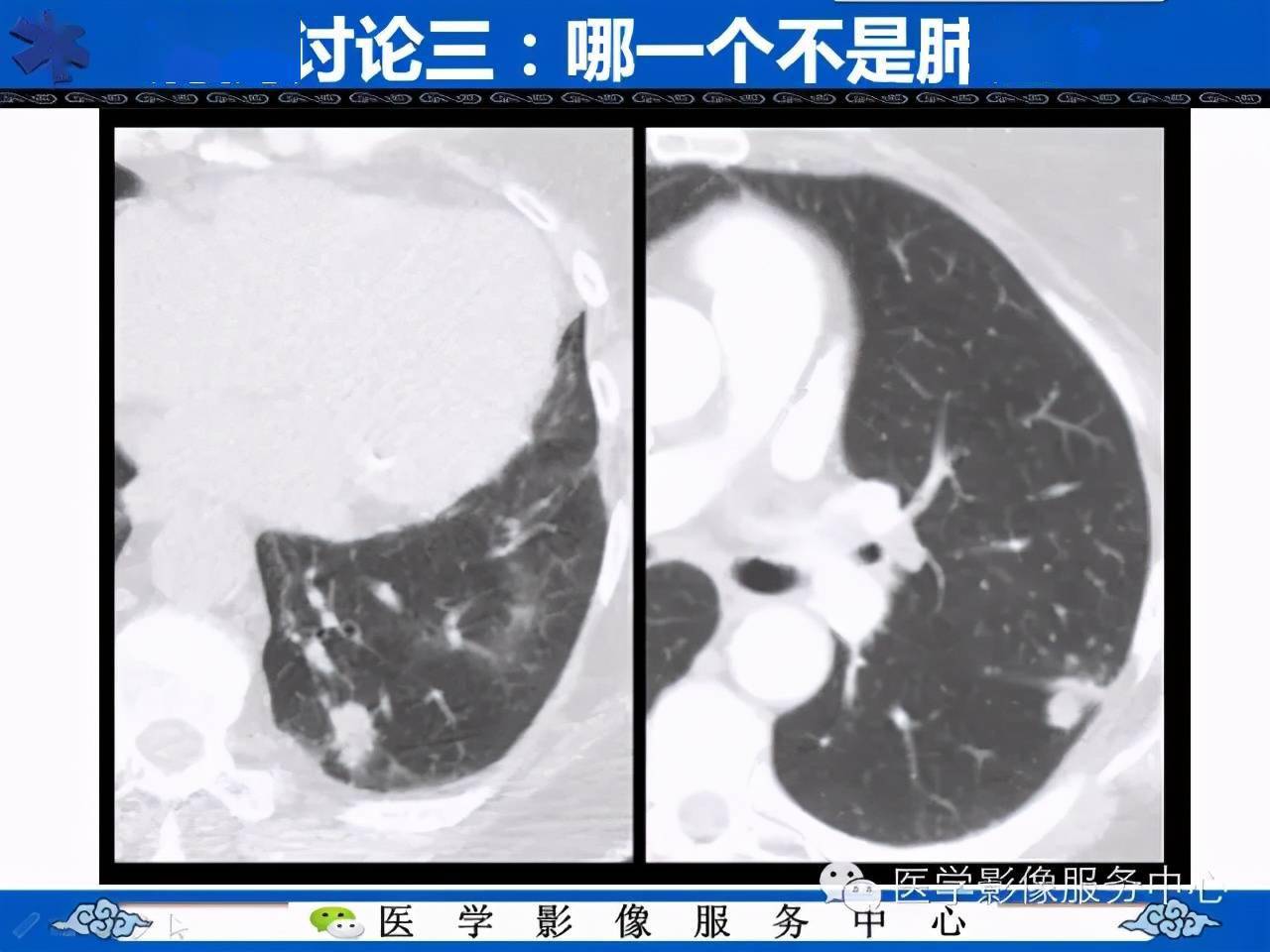 肺癌的影像學鑑別診斷實例哪些不是肺癌