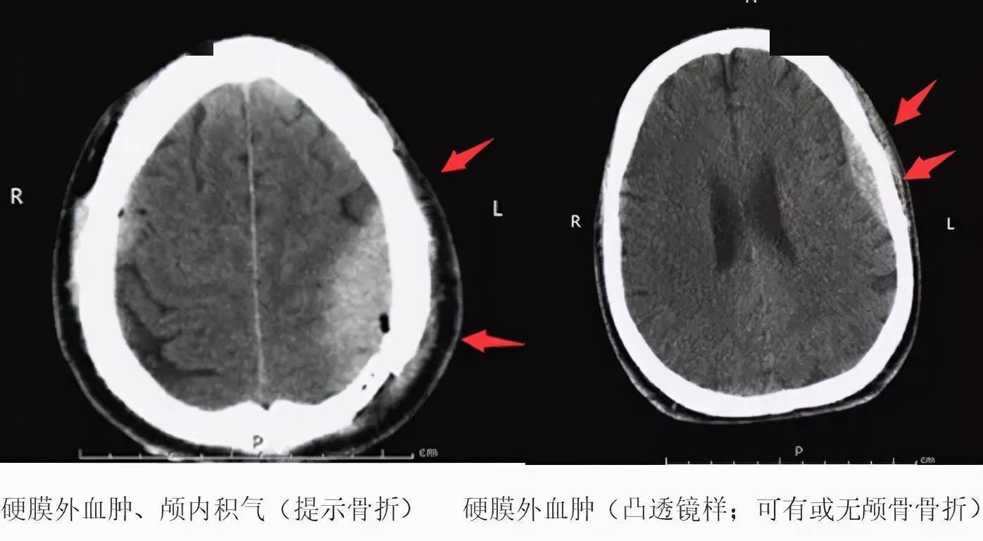 认识这几种头颅 ct,值夜班稳了