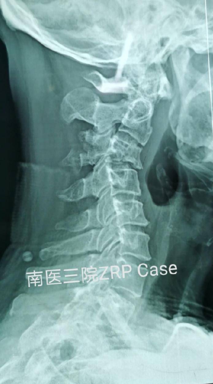 男子贴春联不慎摔断脖子医生提醒怀疑颈部受伤千万别随意搬动