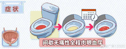膀胱癌的典型症状是什么 病人
