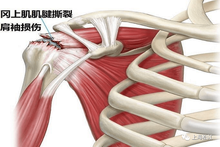 肩袖肌肉包括:肩胛下肌,冈上肌,冈下肌肉和小圆肌.