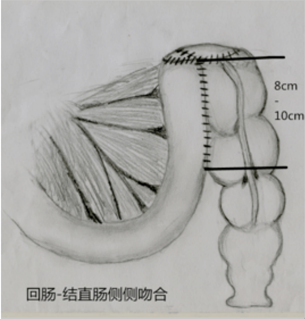 一文读懂慢性便秘如何综合治疗