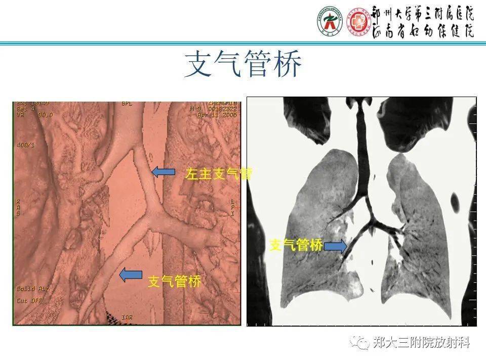 小儿气管及支气管发育畸形的ct诊断