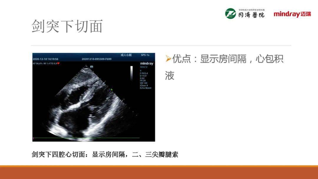 武汉同济医院麻醉科围术期经胸超声心动图tte