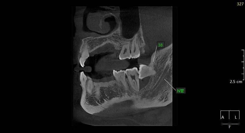 武xx20210222智齿cbct136xxxx9681