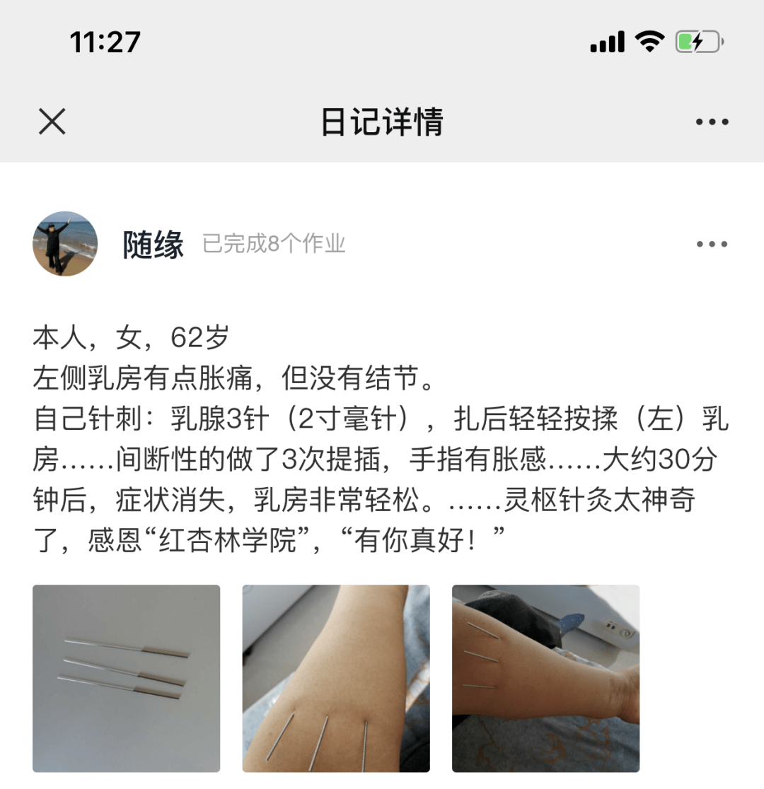 董氏乳腺增生特效三针图片